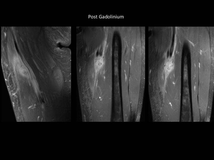 Figure 5 for case myositis ossificans